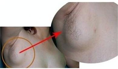 先搞清楚你的是不是副乳#1
